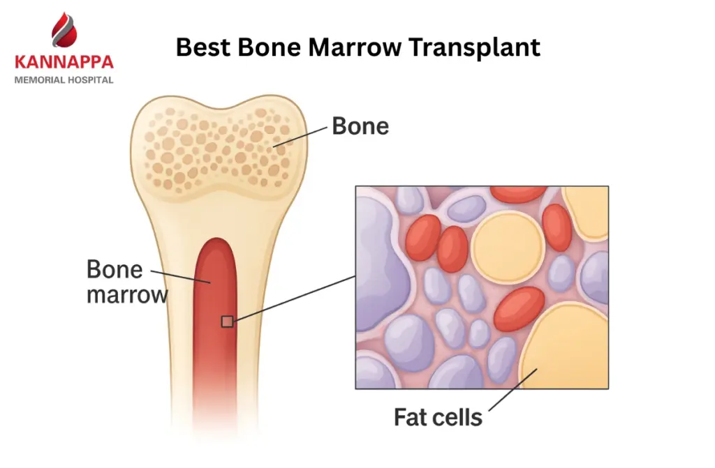 Best Bone Marrow Transplant Hospital in India 