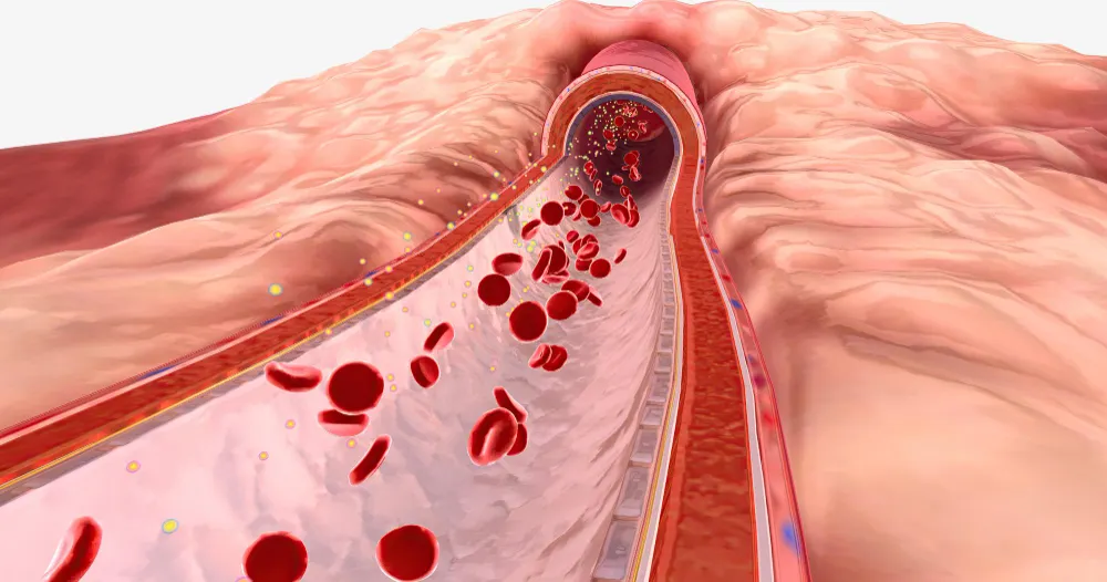 Hemoglobinopathy