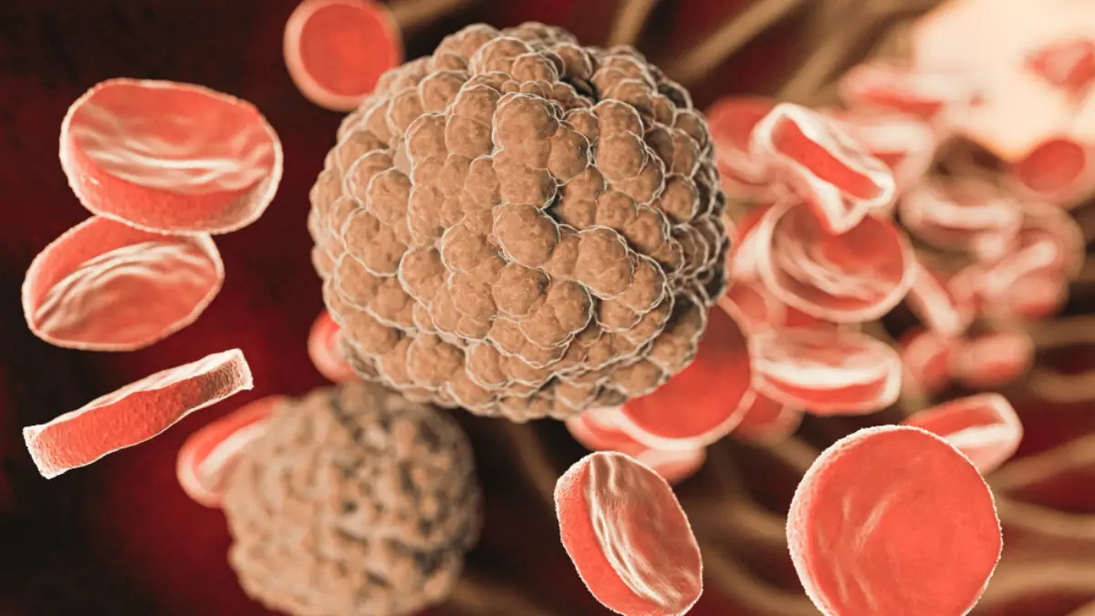 Myelodysplastic Syndromes