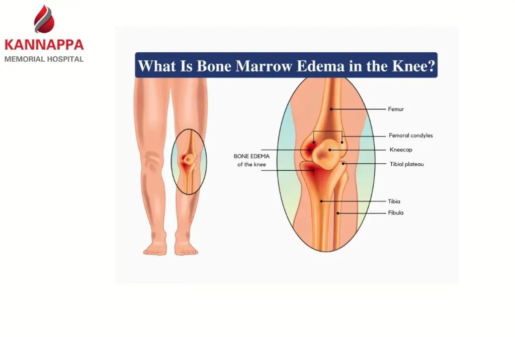 Bone Marrow Edema