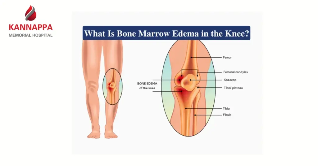 Bone Marrow Edema