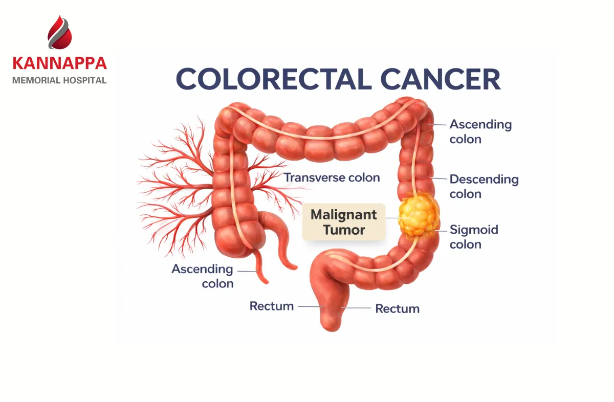 Colorectal Cancer