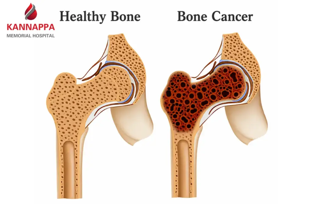 Cancer Spread to Bones